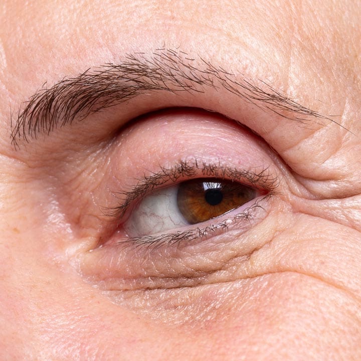 HR Plastic Sugery - Droopy eye brows What Can I do